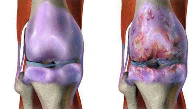 BREAKING: The Best Natural Drink To Strengthen The Knees And Help Rebuild Cartilage And Ligaments