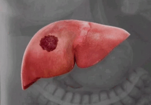 Dangerous Warnings: Everyone Should Avoid Liver Cancer By Staying Away From These Four Things