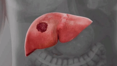Dangerous Warnings: Everyone Should Avoid Liver Cancer By Staying Away From These Four Things