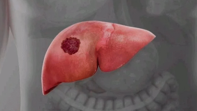 Dangerous Warnings: Everyone Should Avoid Liver Cancer By Staying Away From These Four Things