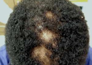 JUST-IN: Signs Of Syphilis That Should Not Be Ignored