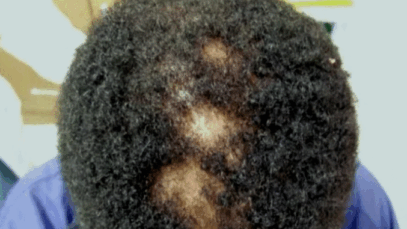 JUST-IN: Signs Of Syphilis That Should Not Be Ignored
