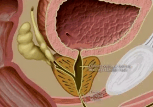 BREAKING: Urine Blockage Kills: Avoid These 5 Habits to Prevent Urine Blockages