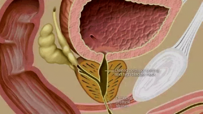 BREAKING: Urine Blockage Kills: Avoid These 5 Habits to Prevent Urine Blockages
