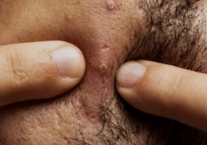 BREAKING: What Causes Pimples in Your Beards? How Can You Prevent That
