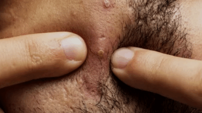 BREAKING: What Causes Pimples in Your Beards? How Can You Prevent That