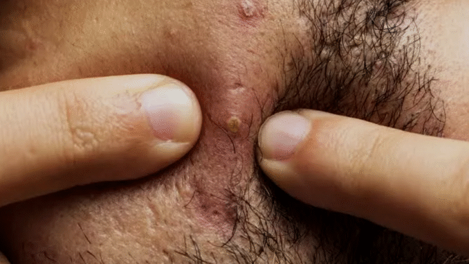 BREAKING: What Causes Pimples in Your Beards? How Can You Prevent That
