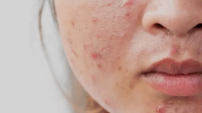 Four 4 Natural Remedies That Can Clear Off Your Pimples or Acne Natural