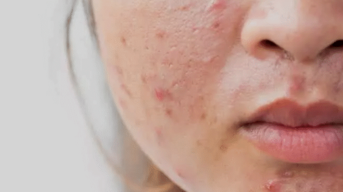 Four 4 Natural Remedies That Can Clear Off Your Pimples or Acne Natural