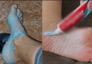 BREAKING NEWS: Get Rid of Cracked Heels with Toothpaste: A Simple and Effective Remedy