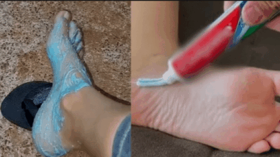 BREAKING NEWS: Get Rid of Cracked Heels with Toothpaste: A Simple and Effective Remedy