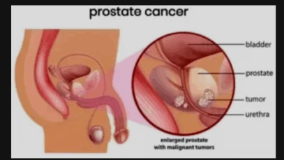 BREAKING NEWS: What Some Men Do On A Regular Basis That Can Cause Prostate Problems