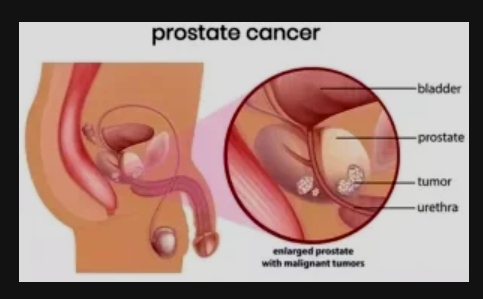 BREAKING NEWS: What Some Men Do On A Regular Basis That Can Cause Prostate Problems