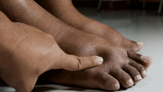 BREAKING: Here’s what causes pregnant women’s feet to swell