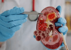5 Signs Of Swollen Kidneys That Should Not Be Ignored