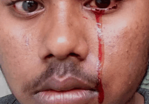 BREAKING NEWS: Crying blood and 5 other strange things that can happen to your eyes