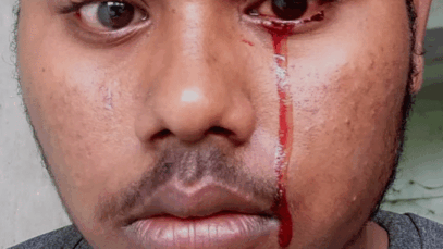 BREAKING NEWS: Crying blood and 5 other strange things that can happen to your eyes