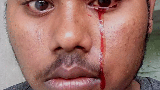 BREAKING NEWS: Crying blood and 5 other strange things that can happen to your eyes