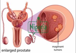 Prostrate Cancer: These Are Food That Causes This Cancer When Taken In Excess
