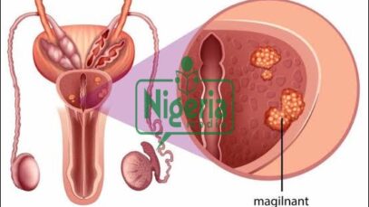 Prostrate Cancer: These Are Food That Causes This Cancer When Taken In Excess