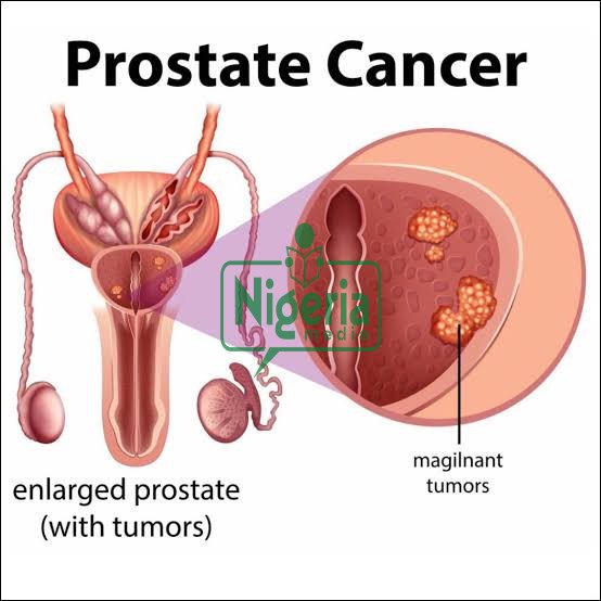 Prostrate Cancer: These Are Food That Causes This Cancer When Taken In Excess