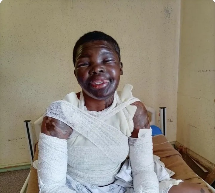 SAD!!! Limpopo Woman Shares Pain After Ex’s Jealous Lover Attacks Her with Acid SAD!!! Limpopo Woman Shares Pain After Ex’s Jealous Lover Attacks Her with Acid