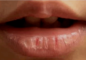 If You Have Dry and Cracked Lips, Here Is What It Means