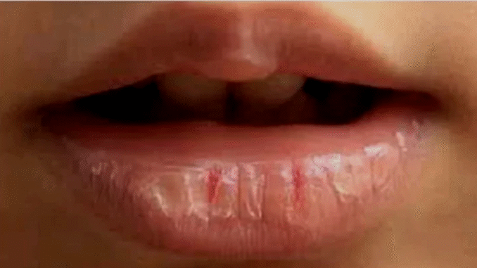 If You Have Dry and Cracked Lips, Here Is What It Means