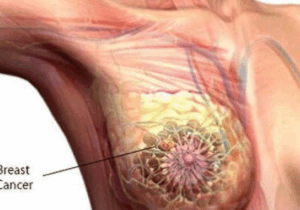 BREAKING: Ladies, Never Ignore These Early Symptoms. They Can Be a Serious Sign For the Following Disease
