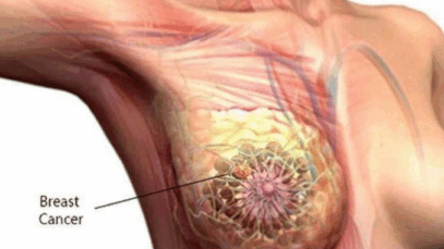 BREAKING: Ladies, Never Ignore These Early Symptoms. They Can Be a Serious Sign For the Following Disease