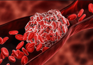 Why are blood clots so deadly? Here are 10 risk factors you should know