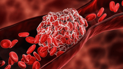 Why are blood clots so deadly? Here are 10 risk factors you should know