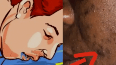 7 Things That Cause Pimples You Need To Stop Doing