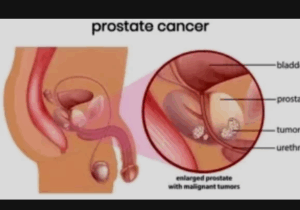 What Some Men Do On A Regular Basis That Can Cause Prostate Problems