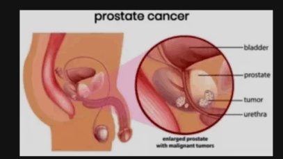 What Some Men Do On A Regular Basis That Can Cause Prostate Problems
