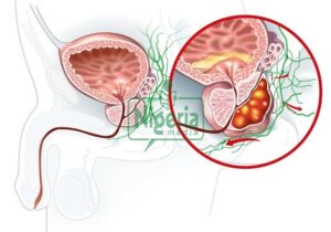 Prostrate Cancer Is Dangerous, Here Are Food That Prevent This